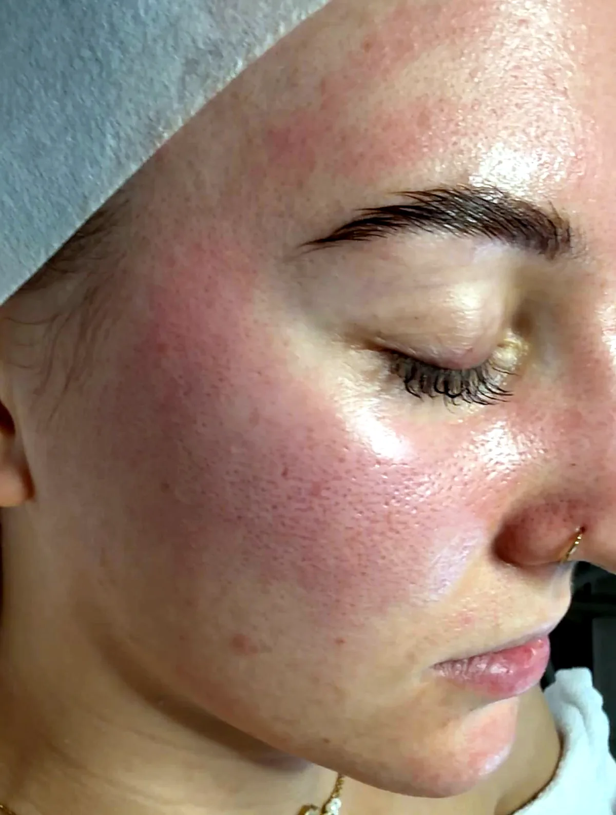 Haut einer Kundin direkt nach dem Lachs-DNA Microneedling bei MOnB