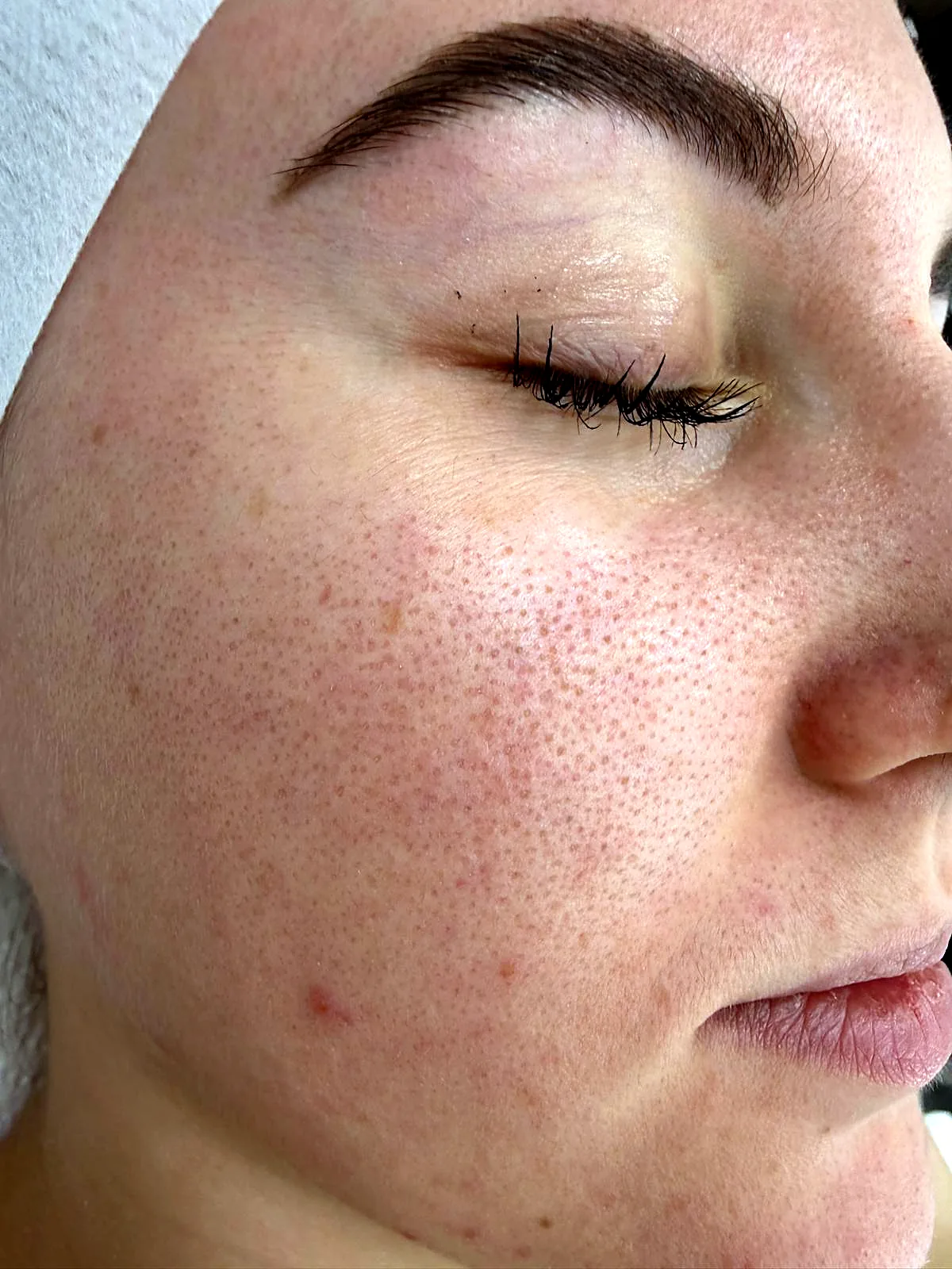 Lachs-DNA Microneedling bei MOnB: Wange einer Kundin direkt nach dem Microneedling