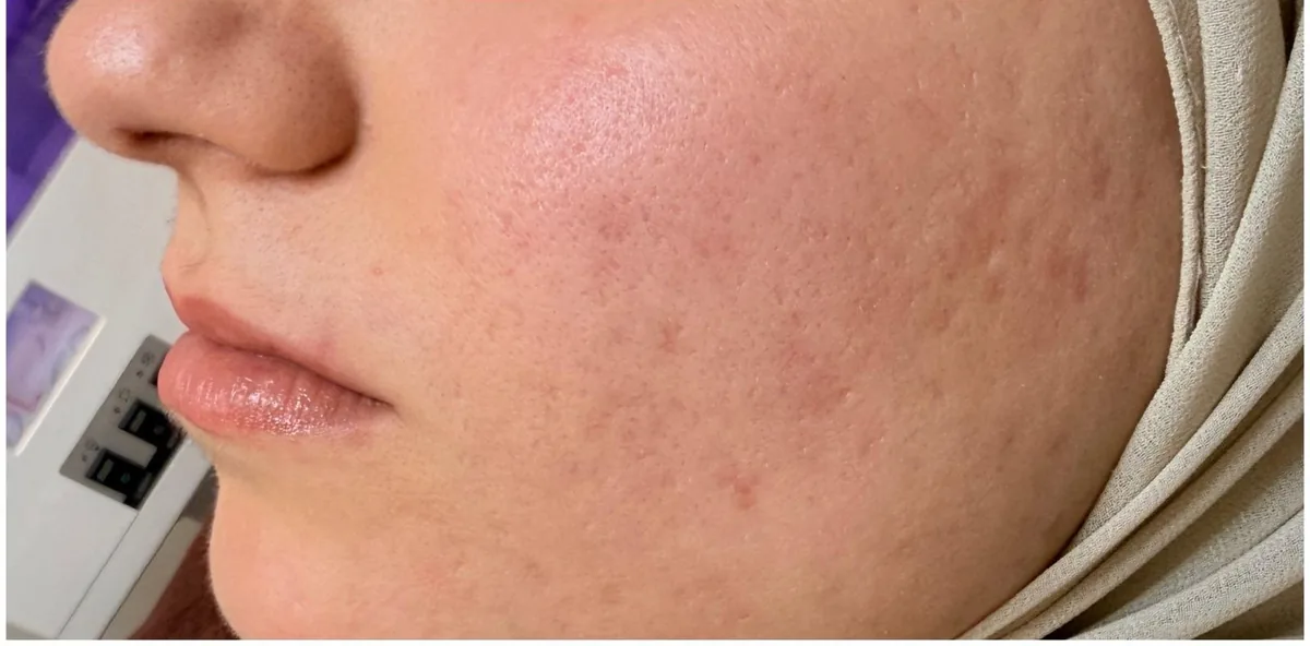 Microneedling Aknenarben – nachher
