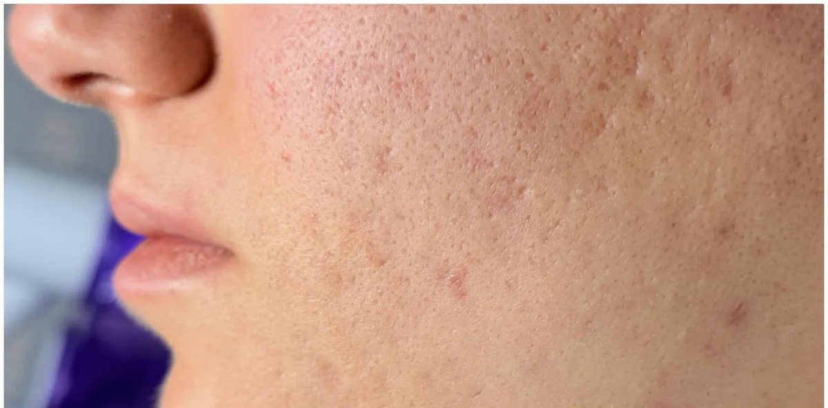 Microneedling Aknenarben – vorher