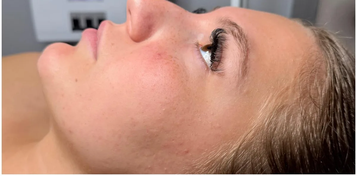Microneedling Unreinheiten & Rötungen – nachher