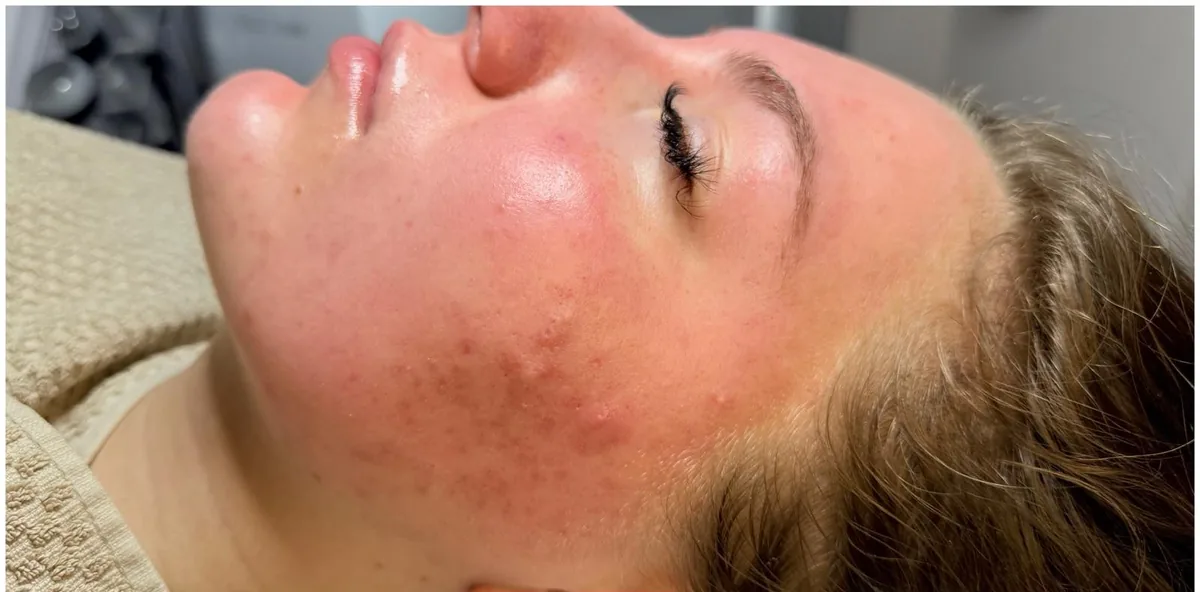 Microneedling Unreinheiten & Rötungen – vorher