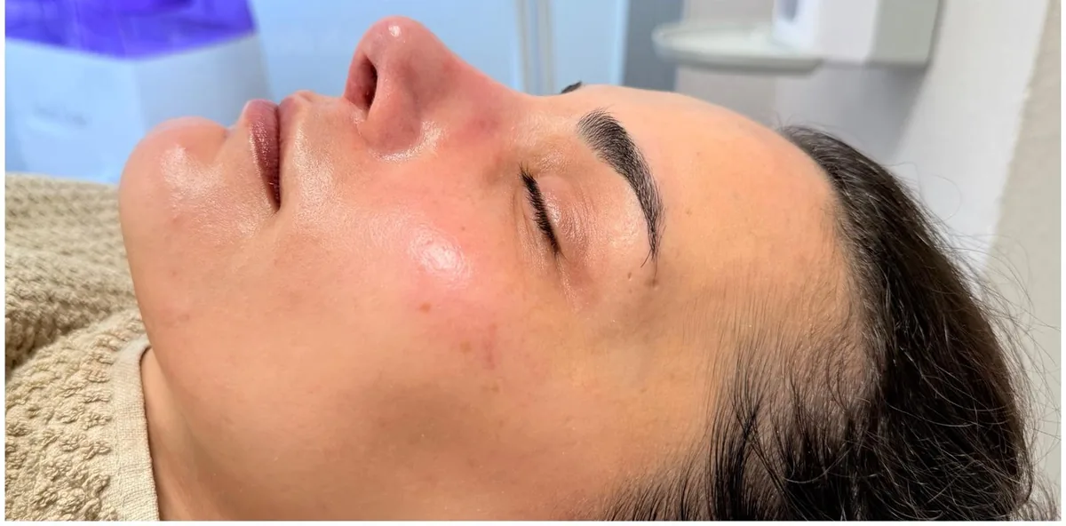 Microneedling Ebenmäßiger Teint – nachher