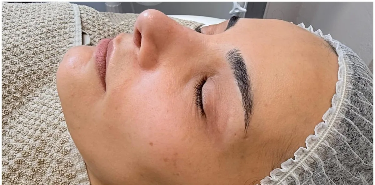 Microneedling Ebenmäßiger Teint – vorher