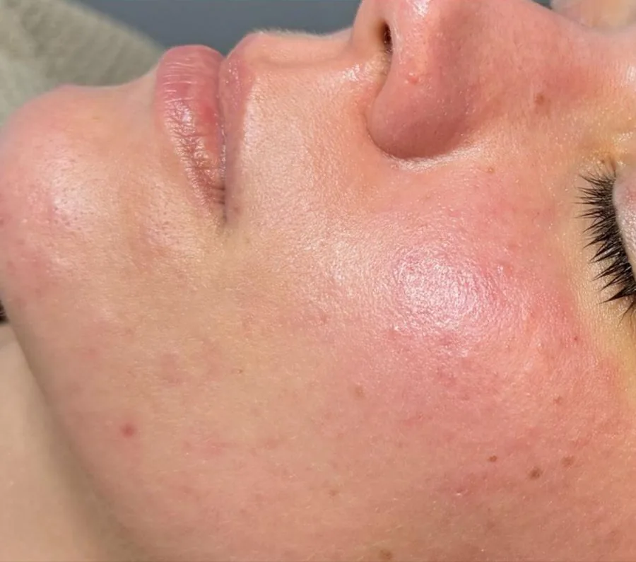 Microneedling Poren & Hautstruktur – nachher