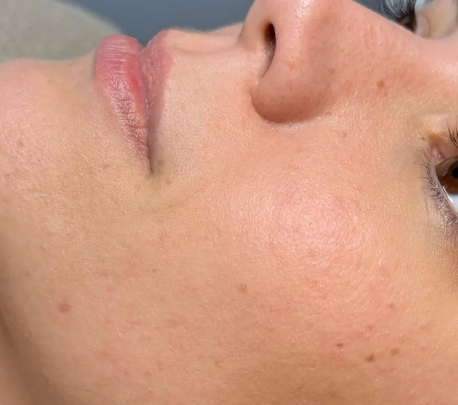 Microneedling Poren & Hautstruktur – vorher
