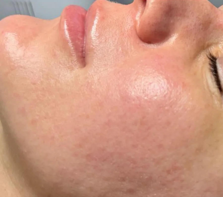 Microneedling Glow & Spannkraft – nachher