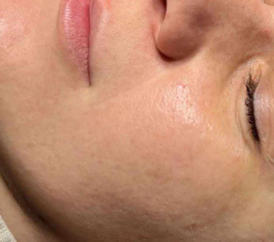 Microneedling Glow & Spannkraft – vorher