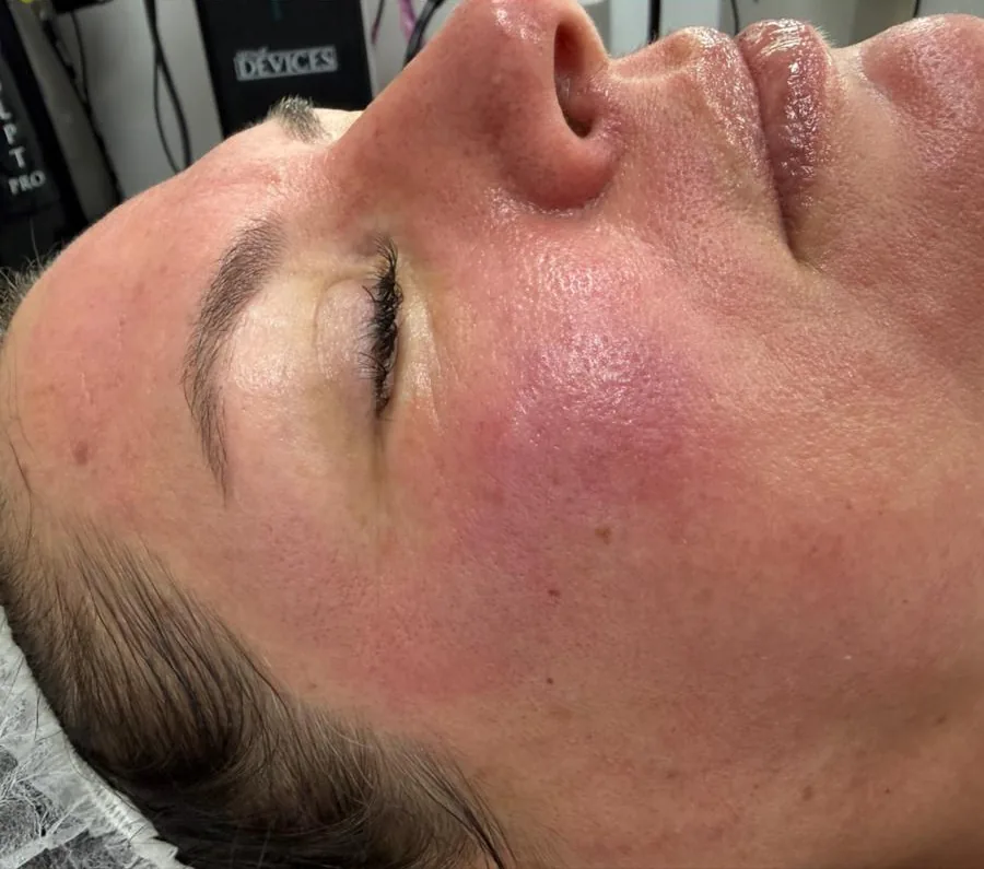 Microneedling Reife Haut – nachher