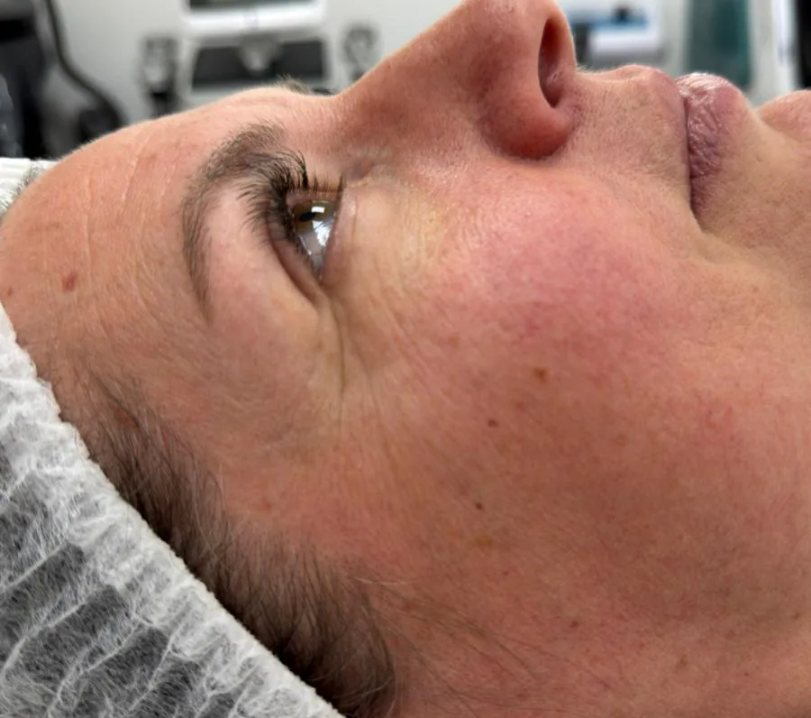 Microneedling Reife Haut – vorher