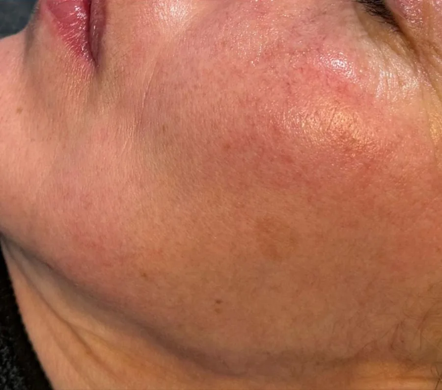 Microneedling Feine Linien – nachher