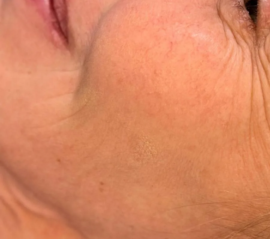 Microneedling Feine Linien – vorher