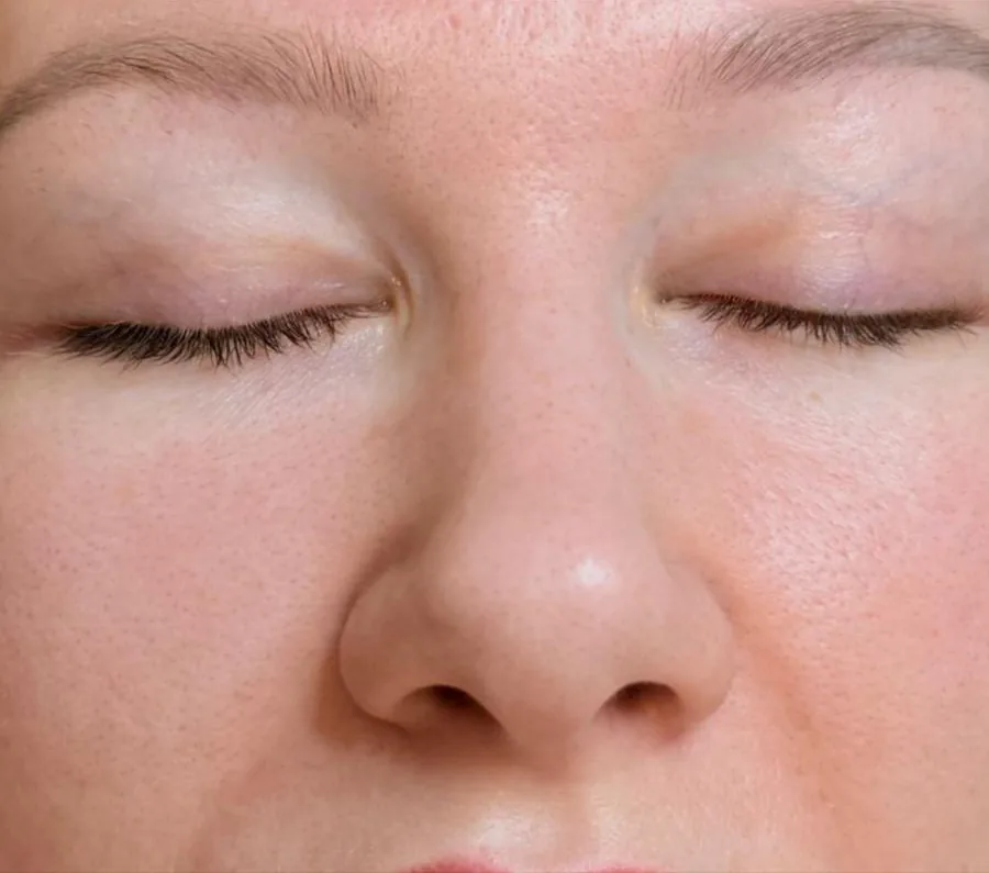 Microneedling Stirn & Augenpartie – nachher