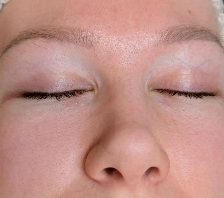 Microneedling Stirn & Augenpartie – vorher