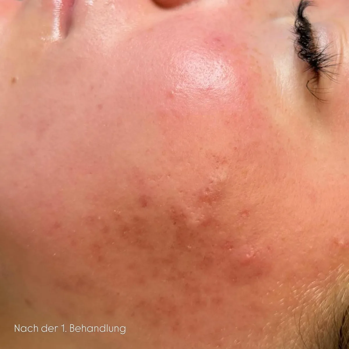 Wange einer Kundin nach der 1. Microneedling-Behandlung