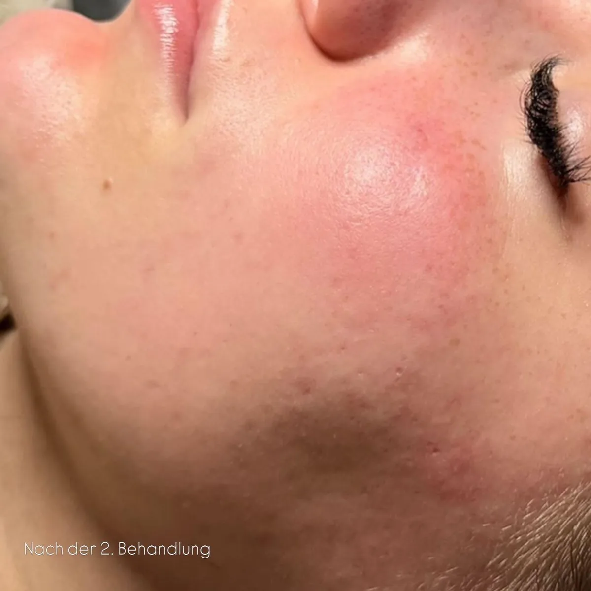 Wange einer Kundin nach der 2. Microneedling-Behandlung